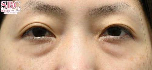 【女性・目元】目の下の切らないクマ・たるみ（ふくらみ）取り、ナチュラル脂肪注射コンデンスリッチ_before