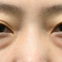 【女性・目元】目の下の切らないクマ・たるみ(ふくらみ)取り、ナチュラル脂肪注射コンデンスリッチ_before