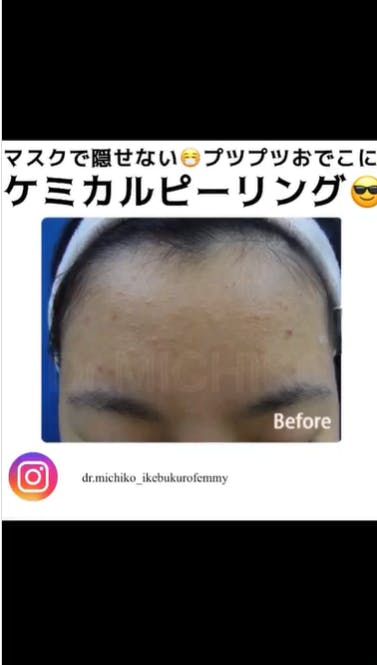 【ニキビ】ケミカルピーリング_before