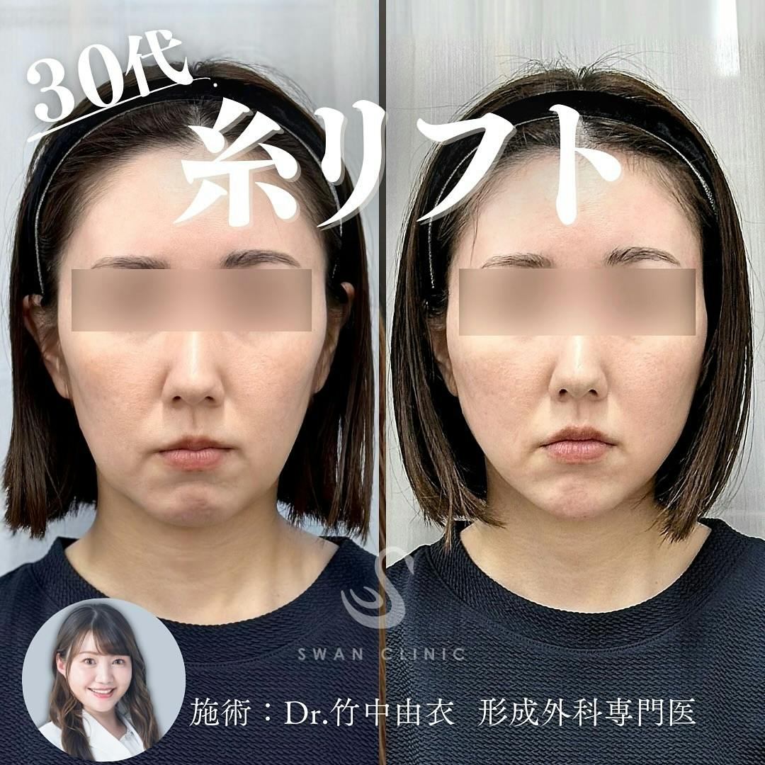 【30代女性・たるみ】糸リフト ボトックス 顎のヒアルロン酸_before_aftar