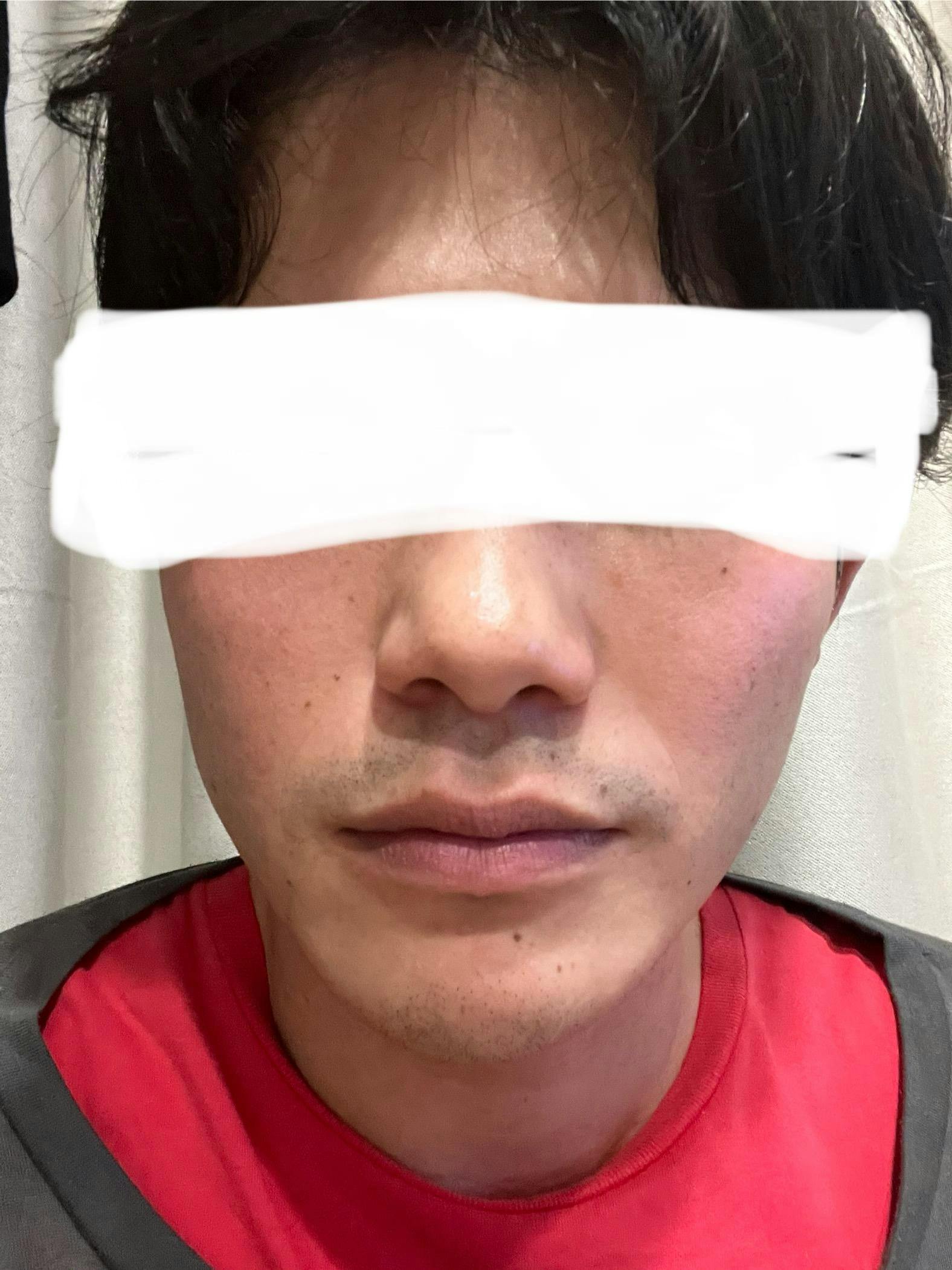 湘南美容クリニック 名古屋駅本院でレーザー脱毛治療を受けたひーちゃんさんの写真