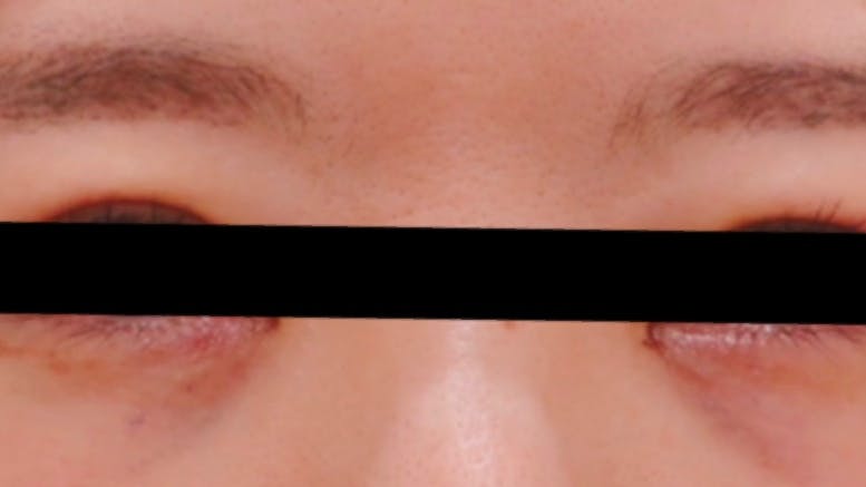 ワムクリニック銀座(WOM CLINIC GINZA)で目の下のくまとり　脱脂のみを受けたまろんさんの写真