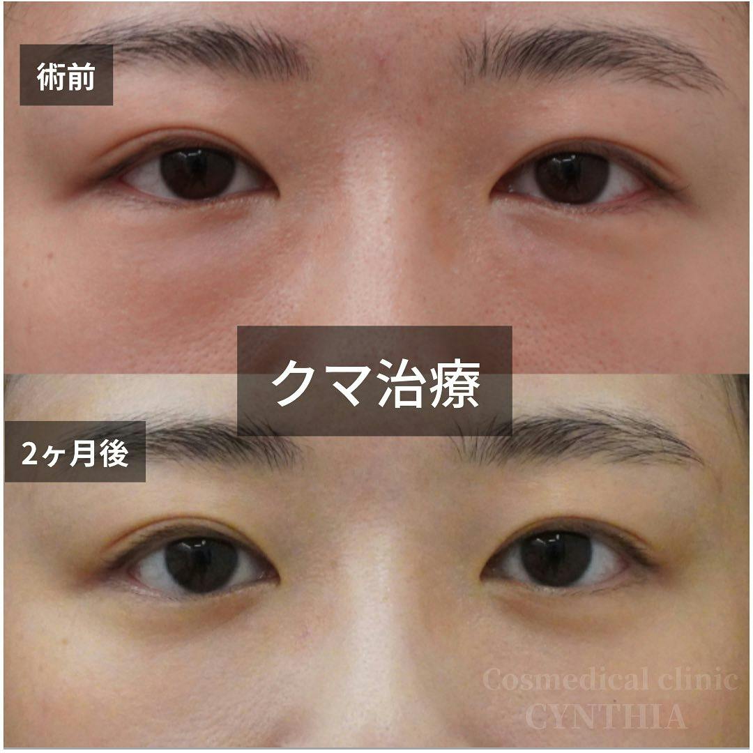 【30代女性・目元】目の下のクマ取り_before_aftar