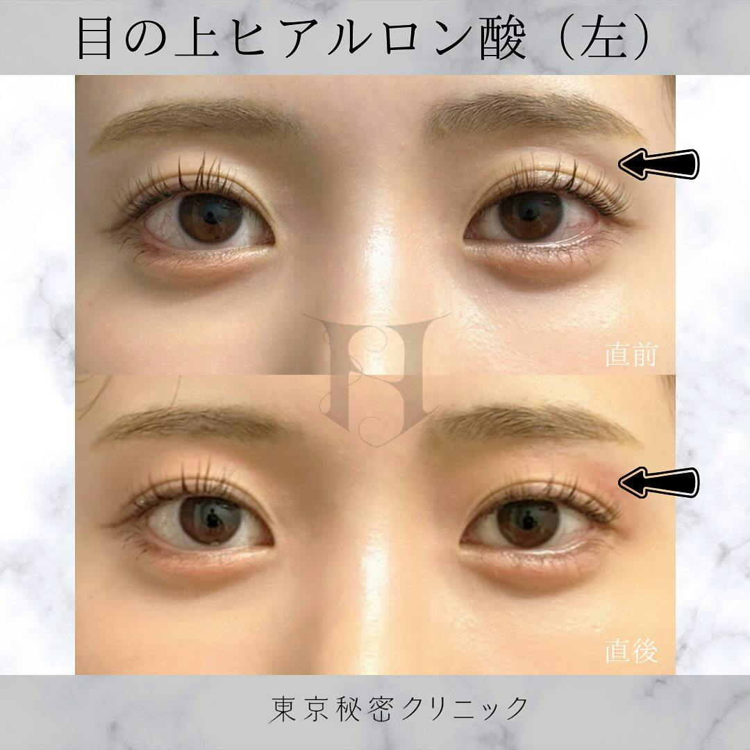 【女性・目元】ヒアルロン酸（目の上）_before_aftar