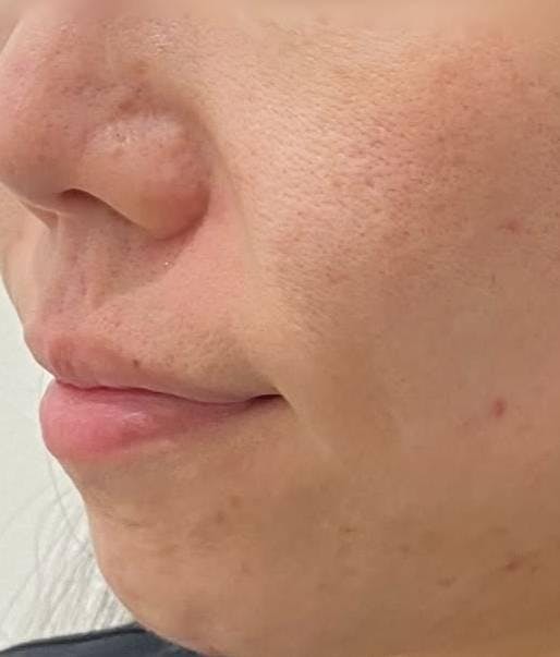 よつば会クリニック 有楽町院で毛穴・ニキビ痕の凹凸：ハイドラジェントル全顔を受けたマグマ会のみっちゃんさんの写真