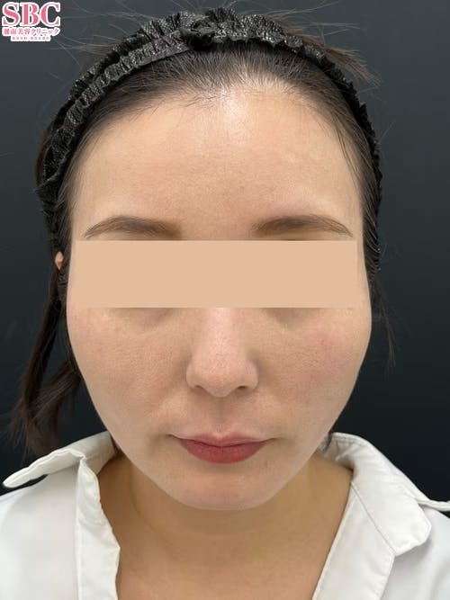 【女性・顔】VOV(ボブ)リフト_after