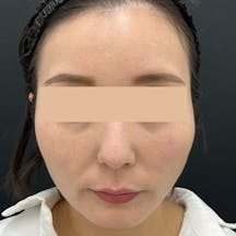 【女性・顔】VOV(ボブ)リフト_after