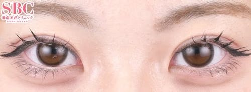 【女性・目元】クイックコスメティーク・ダブルNeo_aftar