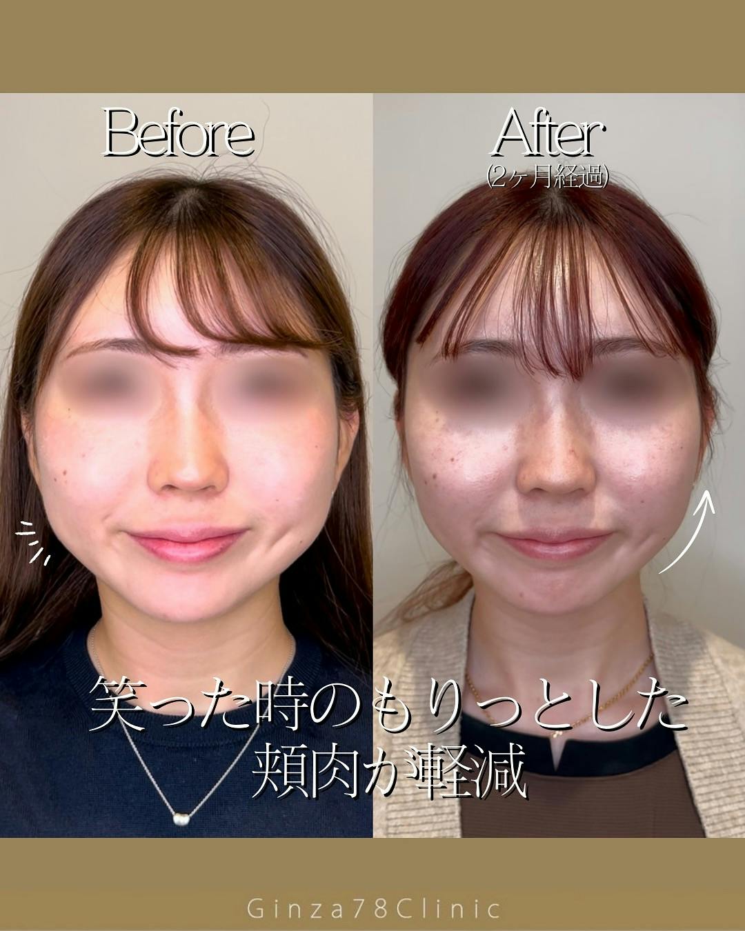 【女性・小顔】バッカルファット除去+糸リフト(G-LIFT flex)_before_aftar
