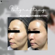 【女性・ハリ】頬コケ·額こめかみ脂肪注入+PRP_before_aftar
