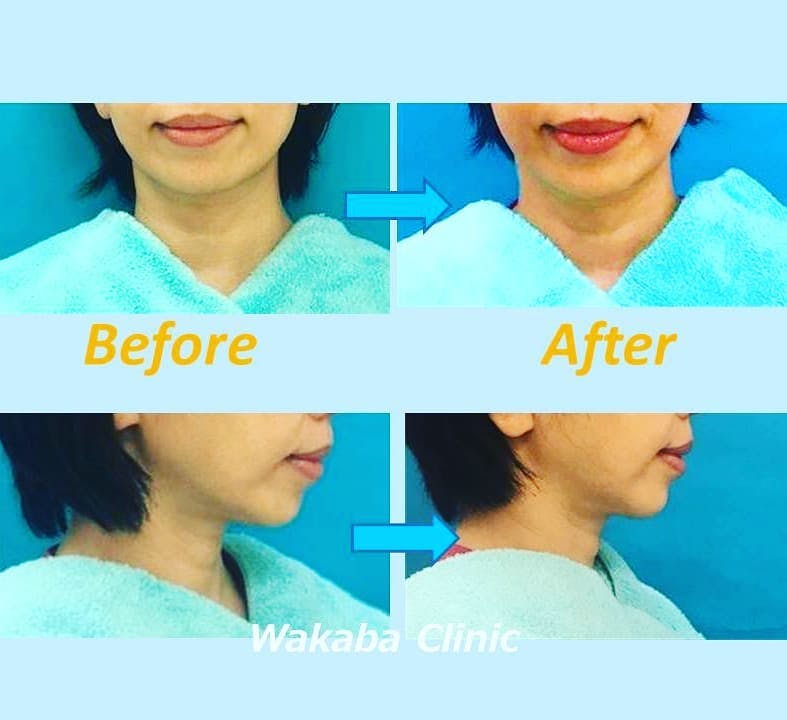 【女性・小顔】脂肪溶解注射_before_aftar