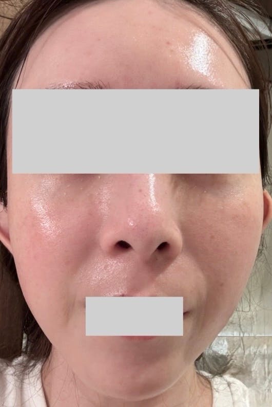 ゼティスビューティークリニック 新宿院(Zetith Beauty Clinic)でサリチル酸マクロゴールピーリングを受けたarai03さんの写真