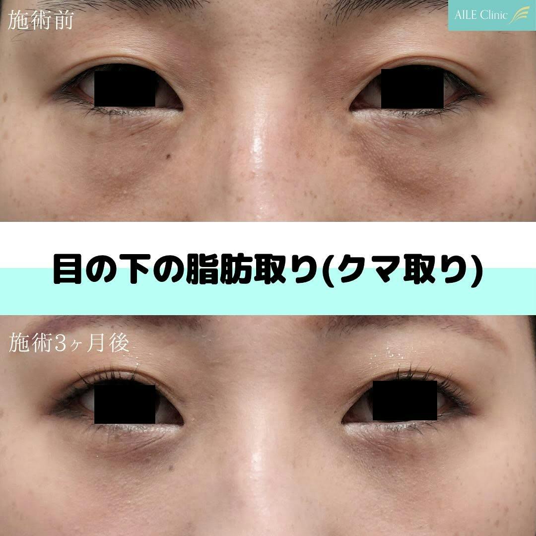 【女性・クマ】目の下の脂肪取り(クマ取り)_before_aftar