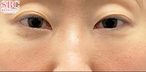 【40代女性・クマ】裏ハムラ法 ナチュラル脂肪注射ナノリッチ_after