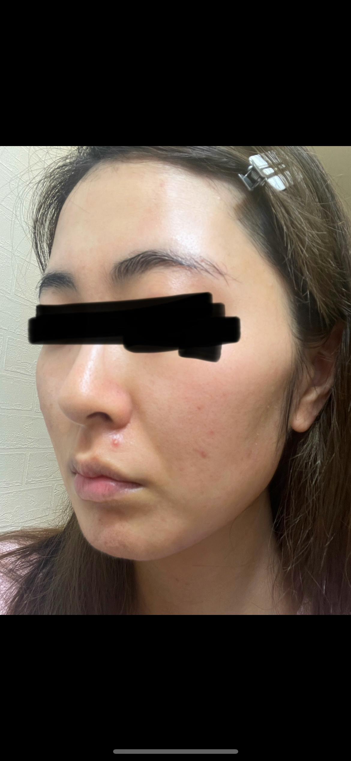 湘南美容クリニック 横浜院でピコトーニングを受けたはるさんの写真