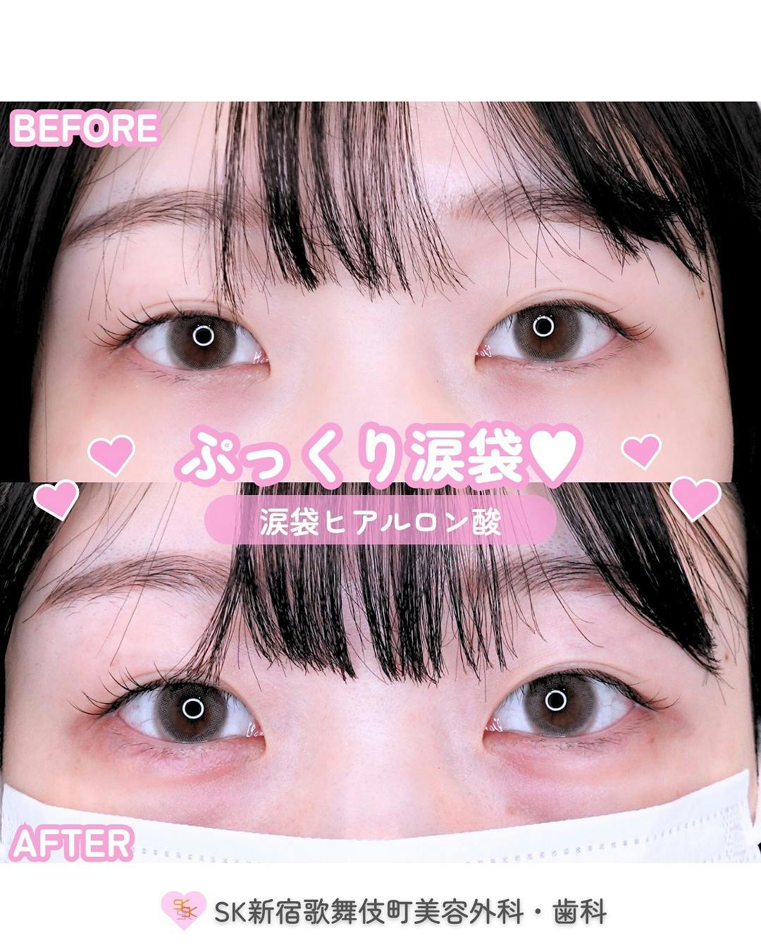 【女性・目元】涙袋ヒアルロン酸_before_aftar