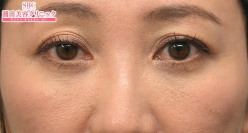 【50代女性・目元】目の下の切らないクマ・たるみ（ふくらみ）取り ナチュラル脂肪注射コンデンスリッチ ナチュラル脂肪注射ナノリッチ_after