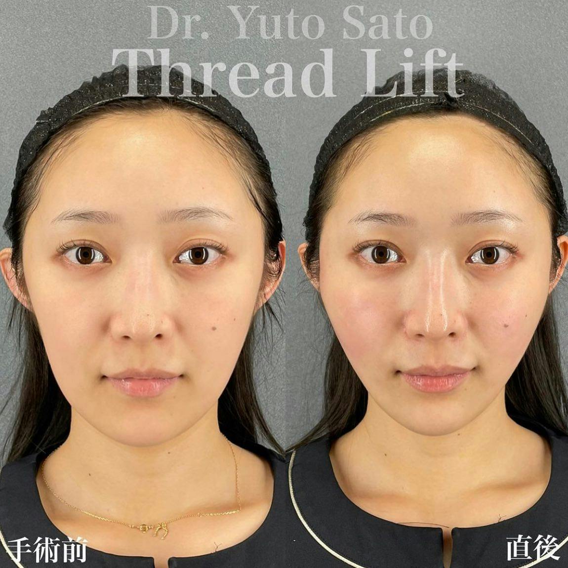 【女性・輪郭】糸リフト_before_aftar