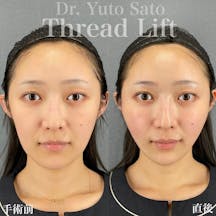 【女性・輪郭】糸リフト_before_aftar