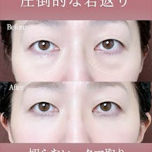 【女性・クマ】切らないクマとり_before_aftar