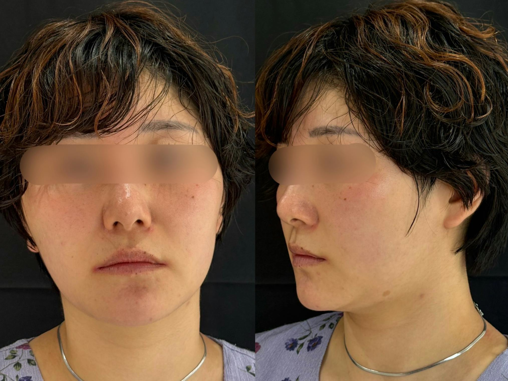 ヒアルロン酸_before