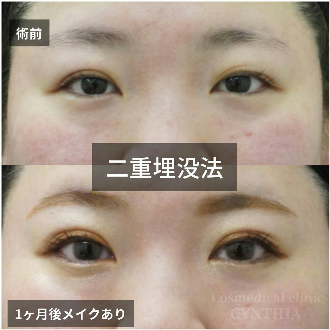 【30代女性・目元】二重埋没法_before_aftar