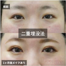 【30代女性・目元】二重埋没法_before_aftar