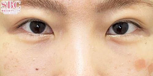 【30代女性・目元】目の下の切らないクマ・たるみ（ふくらみ）取り、ナチュラル脂肪注射ナノリッチ_after