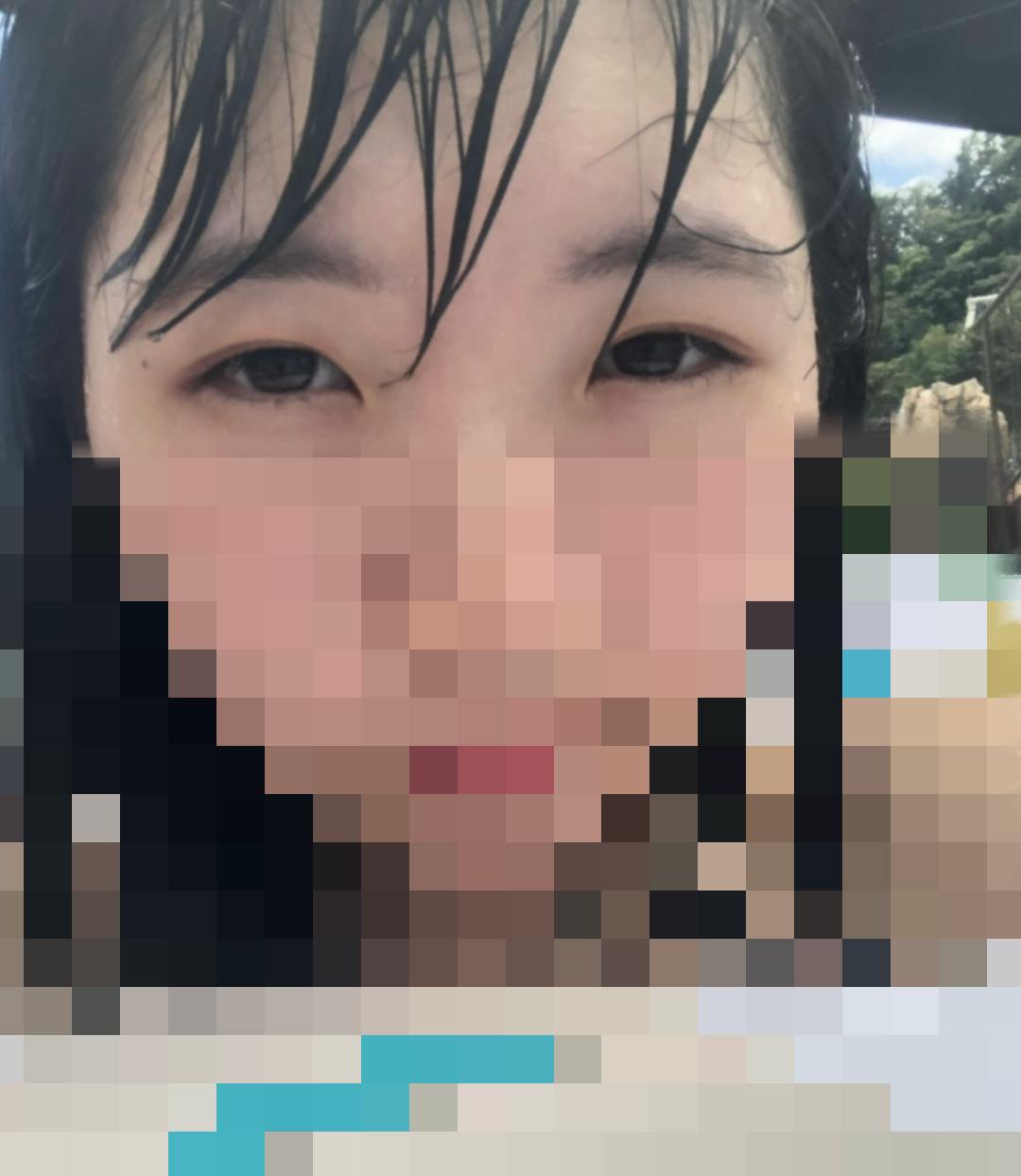 千川形成外科で二重埋没・目頭・蒙古ひだ切開を受けたぽさんの写真