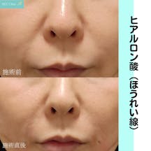 【女性・ほうれい線】ヒアルロン酸注入_before_aftar