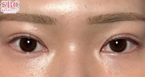 【20代女性・目元】線留めクロス二重術_after