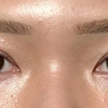 【20代女性・目元】線留めクロス二重術_after