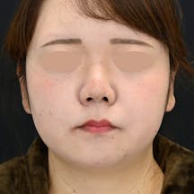 【20代女性・あご】クールスカルプティング(R)・ エリート(クルスカダブル) サクセンダ_before