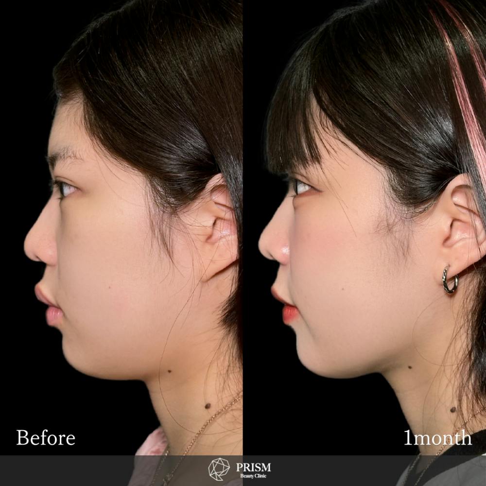 【20代女性・顎下】脂肪吸引クイック（顎下）_before_aftar