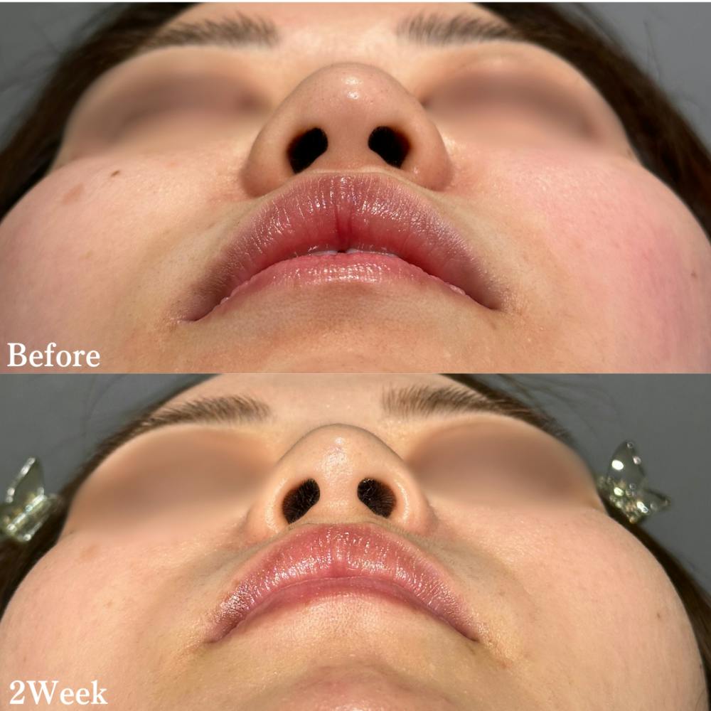 【20代女性・鼻】PRISMノーズスレッド_before_aftar