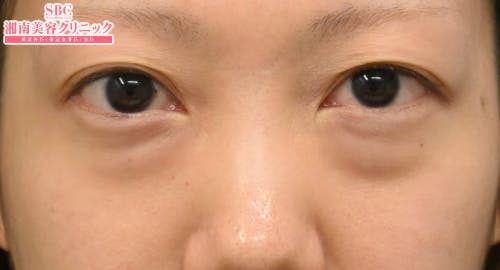 【20代女性・目元】目の下の切らないクマ・たるみ（ふくらみ）取り ナチュラル脂肪注射コンデンスリッチ ナチュラル脂肪注射ナノリッチ_before