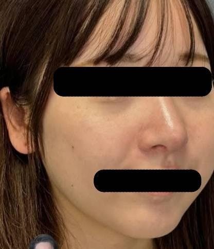 ヴェリテクリニック 銀座院で鼻の整形:鼻尖縮小術を受けたドンさんの写真