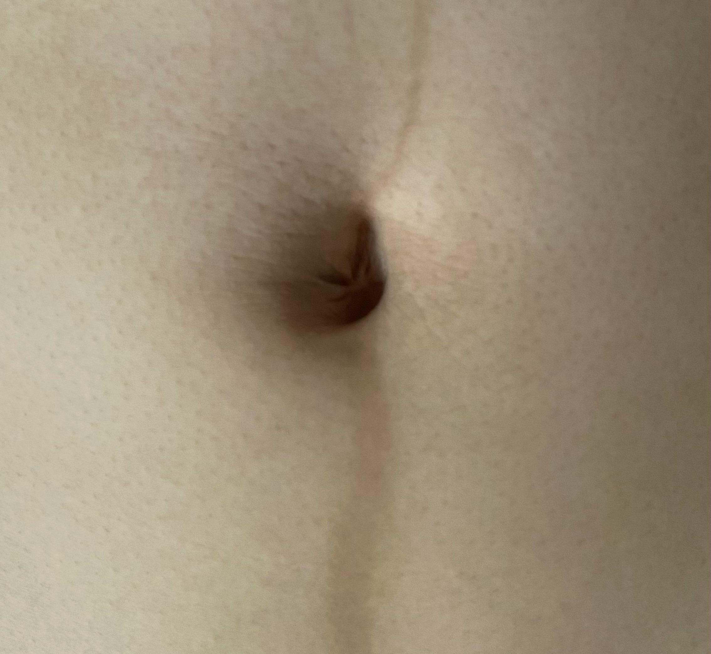 湘南美容クリニック 名古屋院で医療脱毛・鼻下の医療脱毛・乳輪の医療脱毛・うなじの医療脱毛・手の指・甲の医療脱毛・医療脱毛(顎下・首)・顎の医療脱毛・足の指・甲の医療脱毛・額の医療脱毛・Vライン医療脱毛・Iライン医療脱毛・Oライン医療脱毛・膝の医療脱毛・へそまわりの医療脱毛を受けたあいさんの写真