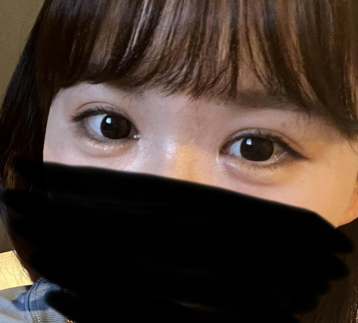 湘南美容クリニック  名古屋栄院で二重埋没を受けたみかさんの写真