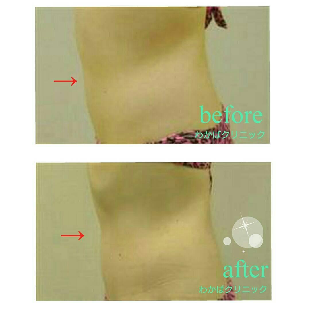 【女性・腹部】ウルティマアンサンブル_before_aftar