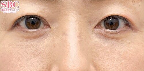 【女性・クマ】目の下の切らないクマ・たるみ（ふくらみ）取り ナチュラル脂肪注射コンデンスリッチ ナチュラル脂肪注射ナノリッチ_after