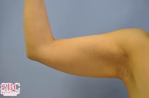 【女性・二の腕】根こそぎVASER脂肪吸引、ライポマティック脂肪吸引、Aquicell（アキーセル）脂肪吸引_before