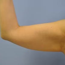 【女性・二の腕】根こそぎVASER脂肪吸引、ライポマティック脂肪吸引、Aquicell(アキーセル)脂肪吸引_before