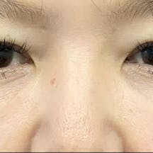 【女性・目元】目の下の切らないクマ・たるみ(ふくらみ)取り、ナチュラル脂肪注射コンデンスリッチ_after