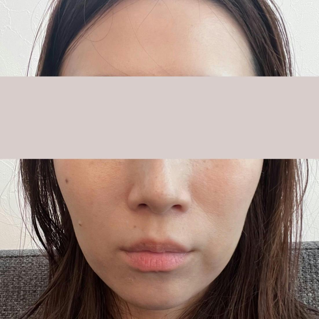 湘南美容クリニック 池袋メトロポリタン口院でを受けたmimimiさんの写真