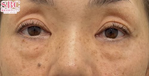 【女性・クマ】目の下の切らないクマ・たるみ（ふくらみ）取り ナチュラル脂肪注射_before