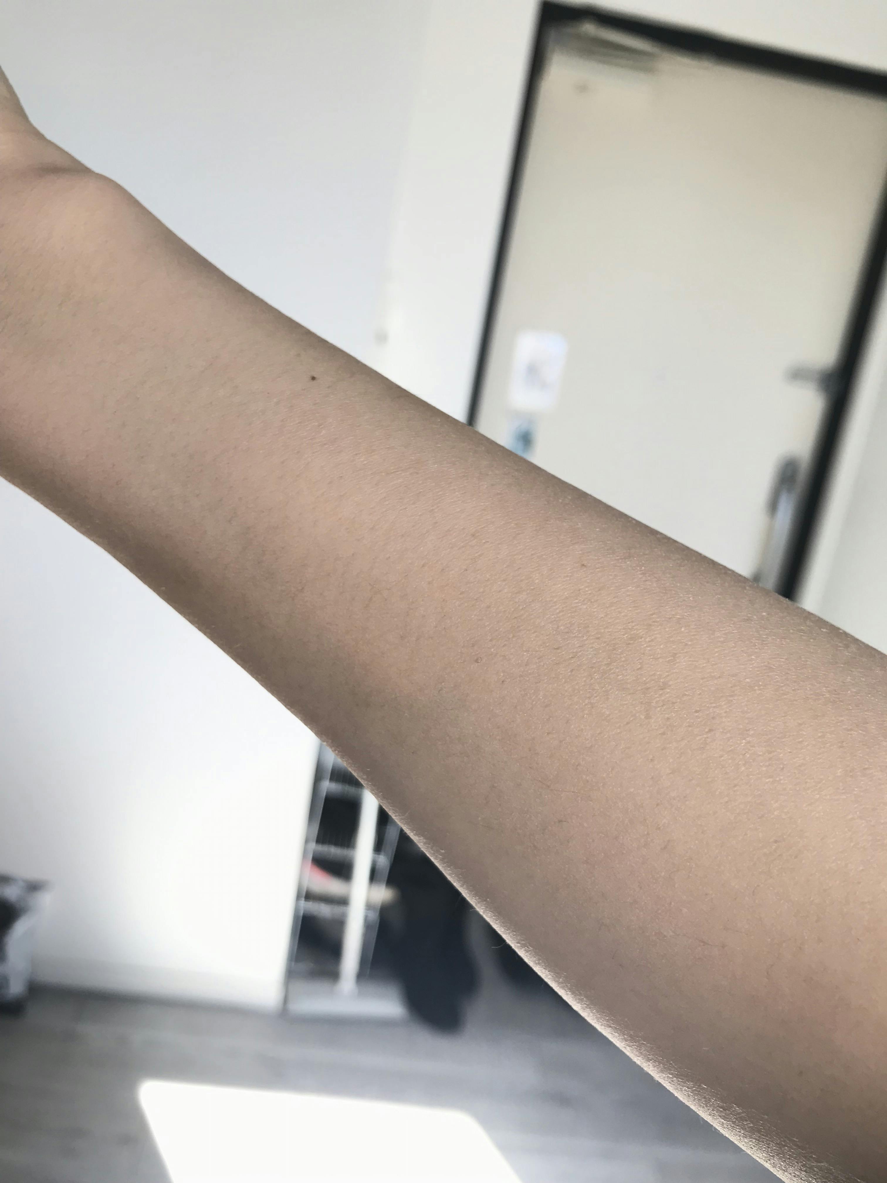 ルラ美容クリニック 渋谷本院でほくろ・いぼ除去を受けた山藤さんの写真