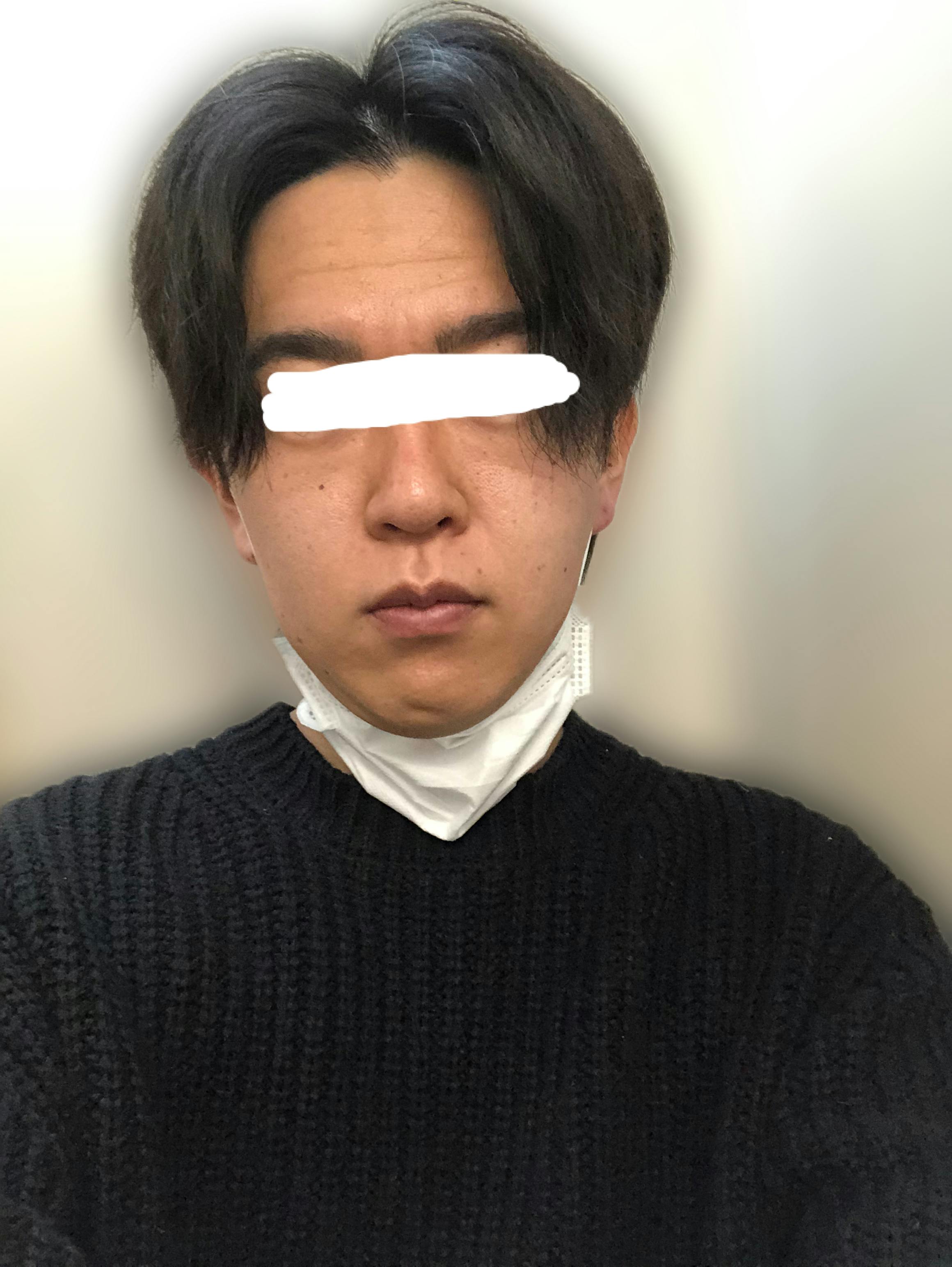 難波セントラルクリニックで全顔ハイフを受けたひろさんの写真