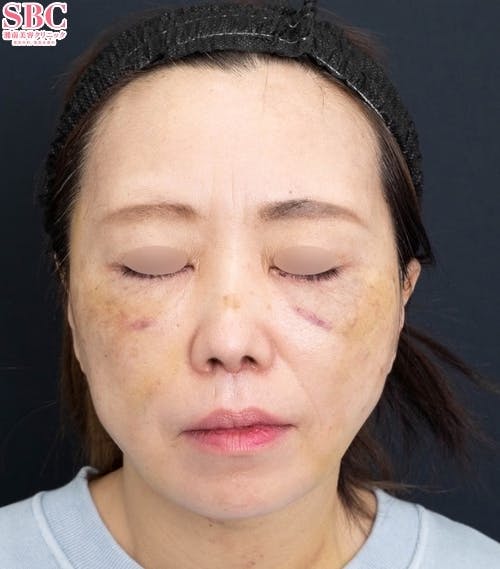 【40代女性・顔】アイバックリムーブ法、VASER併用アキーセル脂肪吸引、ナチュラル脂肪注射コンデンスリッチ、ナチュラル脂肪注射ナノリッチ、SBCプリマリフト、シークレットリフト、VOVリフト_1week