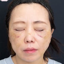 【40代女性・顔】アイバックリムーブ法、VASER併用アキーセル脂肪吸引、ナチュラル脂肪注射コンデンスリッチ、ナチュラル脂肪注射ナノリッチ、SBCプリマリフト、シークレットリフト、VOVリフト_1week